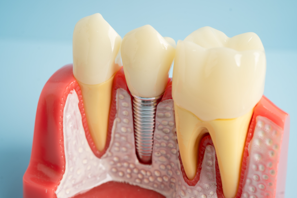Maquette dentaire représentant un implant dentaire métallique situé entre deux dents naturelles coiffées de couronnes artificielles, illustrant la manière dont un implant dentaire s'intègre dans la gencive et l'os maxillaire, comme l'explique le Dr Ikram Elouafi, dentiste, dans son cabinet dentaire de Casablanca.